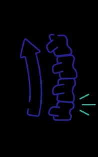 Sciatica